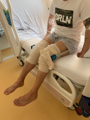 58-year-old patient femoral limb lengthening surgery