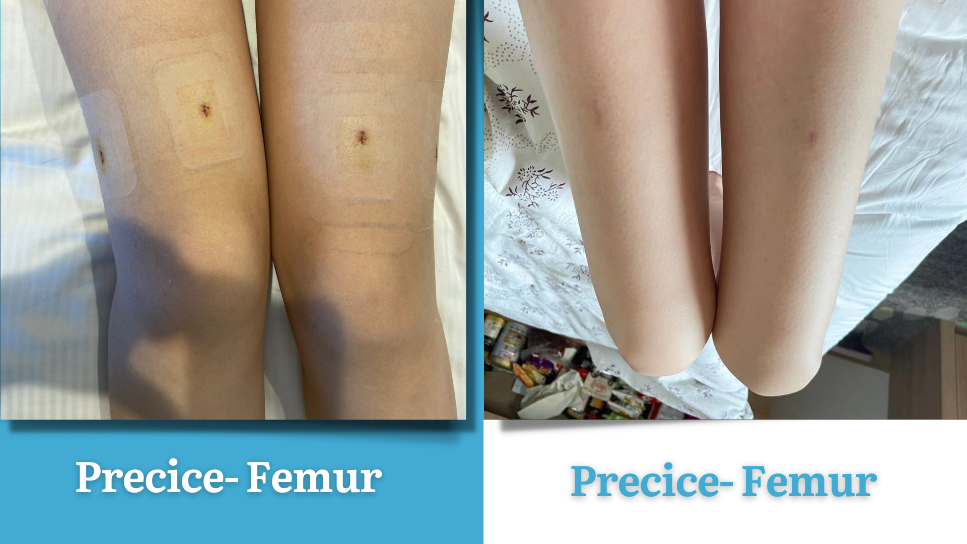 Does Leg Lengthening Surgery Leave Scars? Precice method