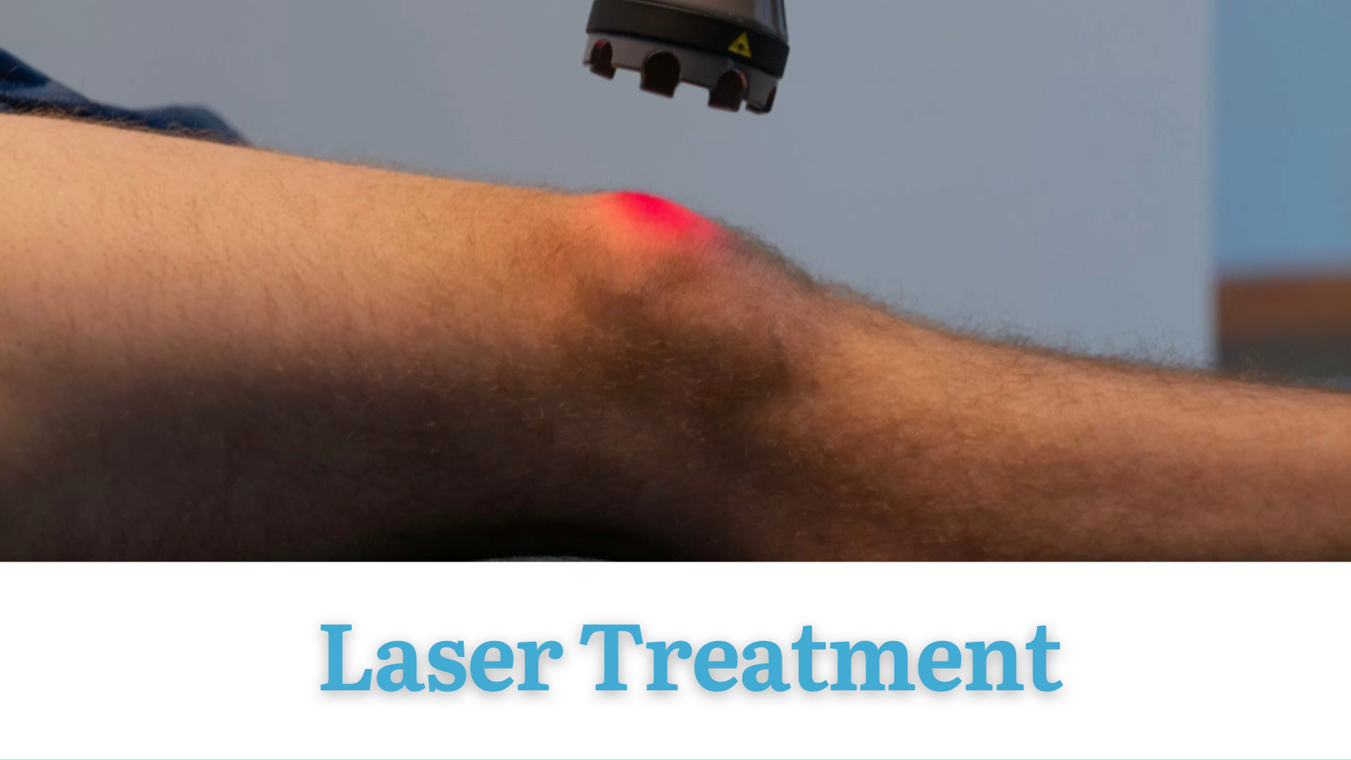 Regular laser scarring treatment