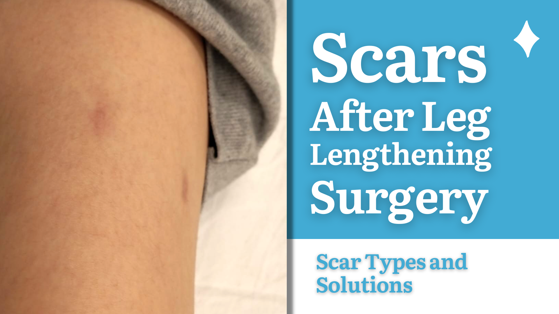 Leg lengthening surgery scars