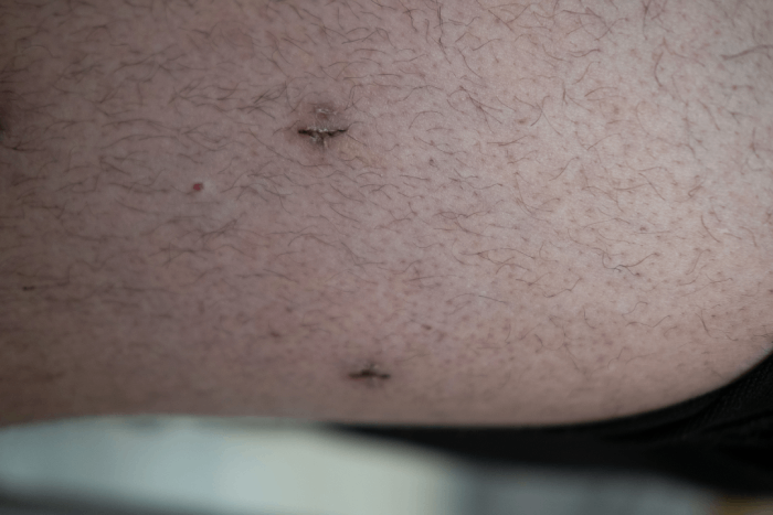 scars after device removal surgery