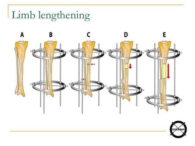 everything about lon method limb lengthening