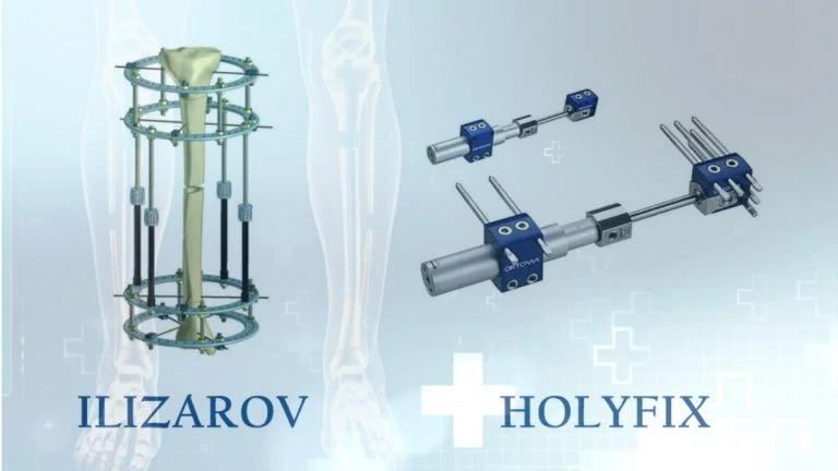 External Limb Lengthening Methods: Ilizarov And Holyfix
