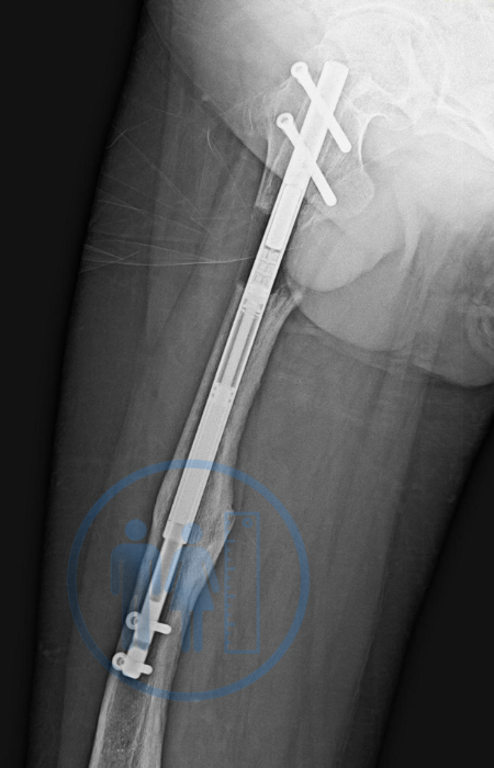 limb lengthening surgery X-Ray