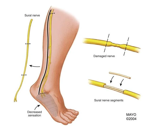 limb lengthening nerve damage