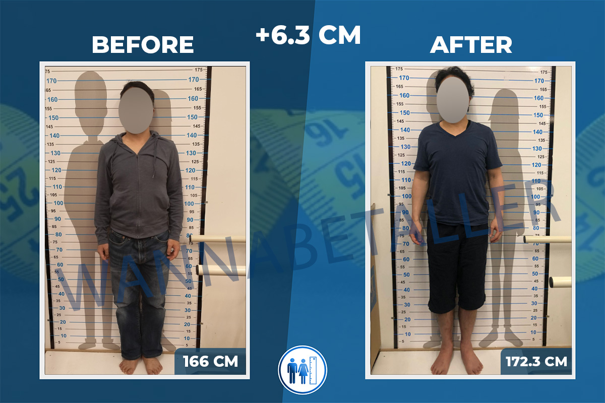 13cm Growth with 2 Limb Lengthening Surgeries