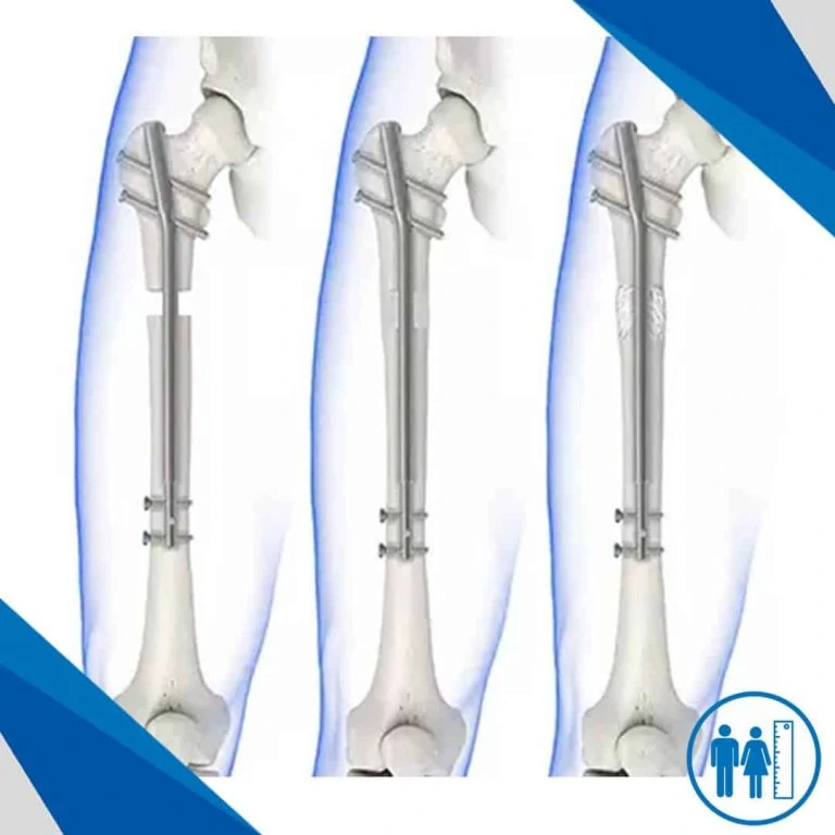 Limb Lengthening Post-op Period, Problems And Complications