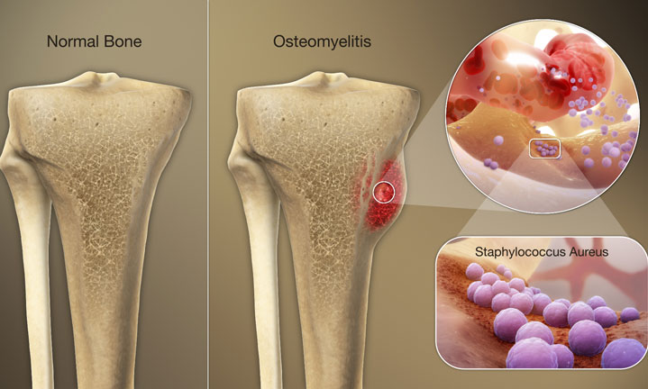osteomyelitis-affected-area