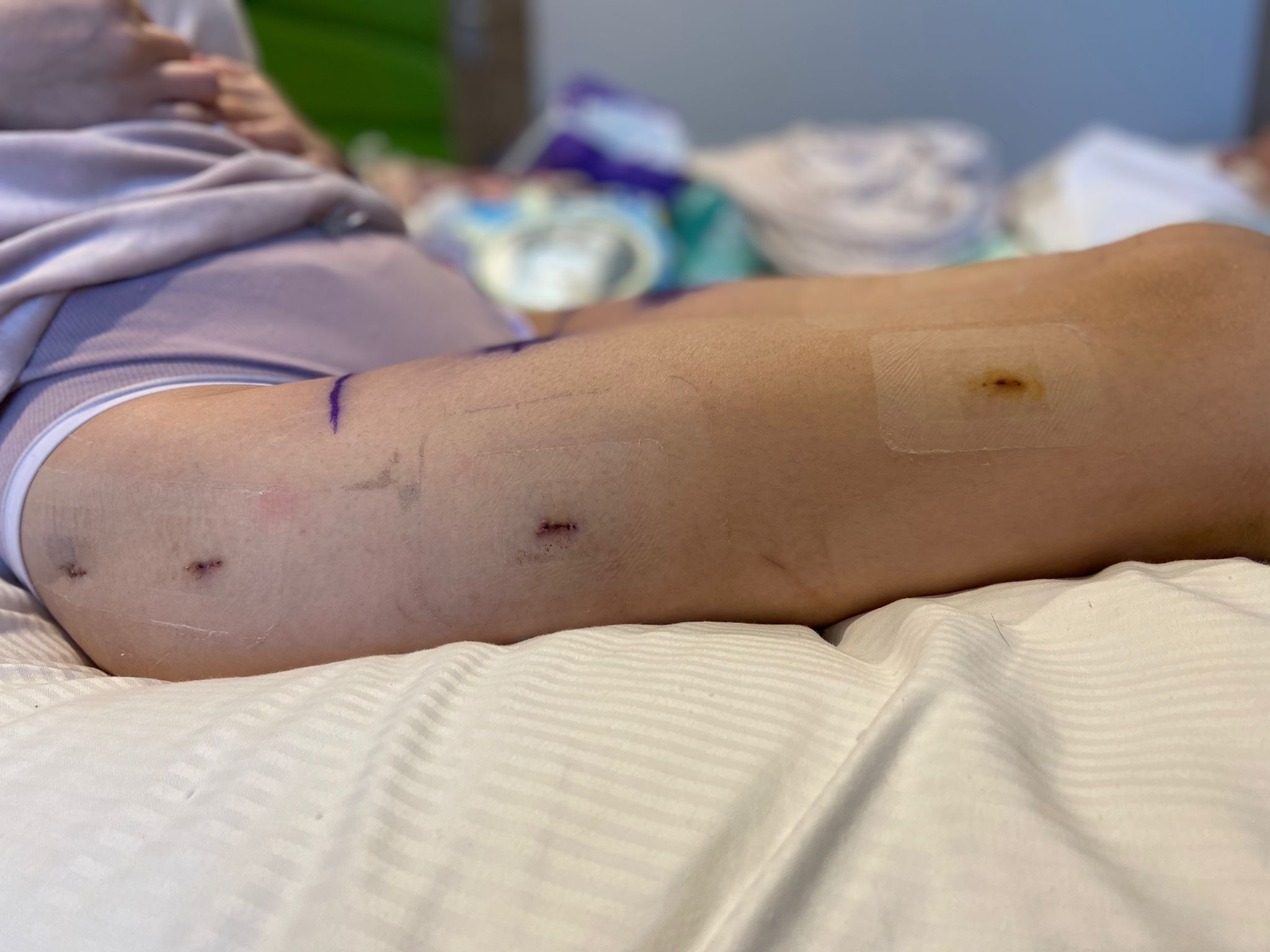 Scars 1 week after leg lengthening surgery 