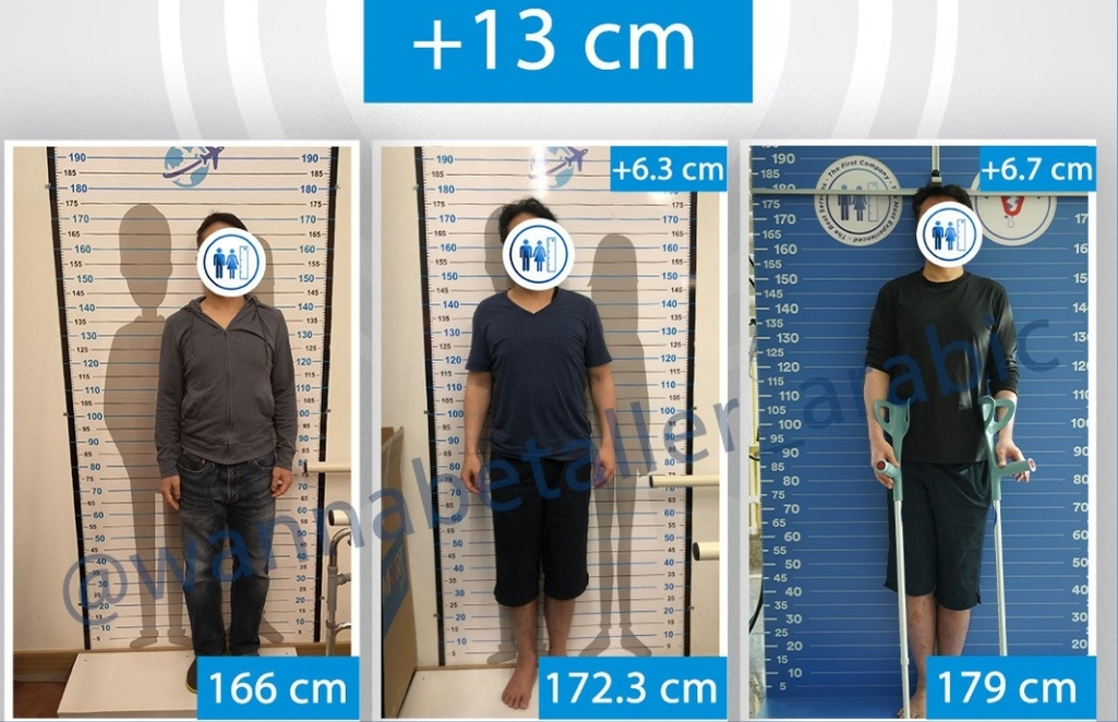 13cm Growth with 2 Limb Lengthening Surgeries
