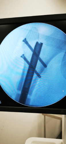 この X 線写真は、患者さまの骨の内側にある骨髄内釘を示しています