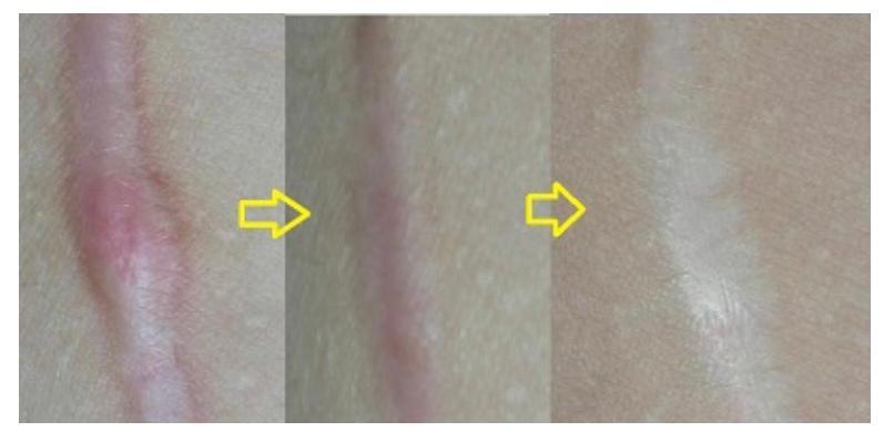 The Price of the Fractional Laser Treatment