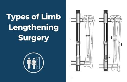 Types of Limb Lengthening Surgery