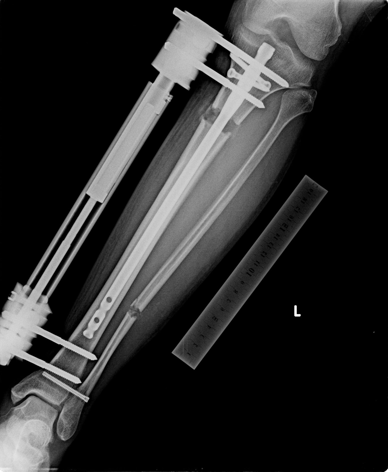 wannabetaller-x-ray-1.3cm