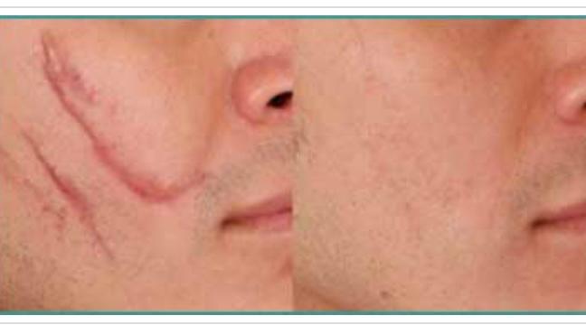 What is Fractional Laser Treatment