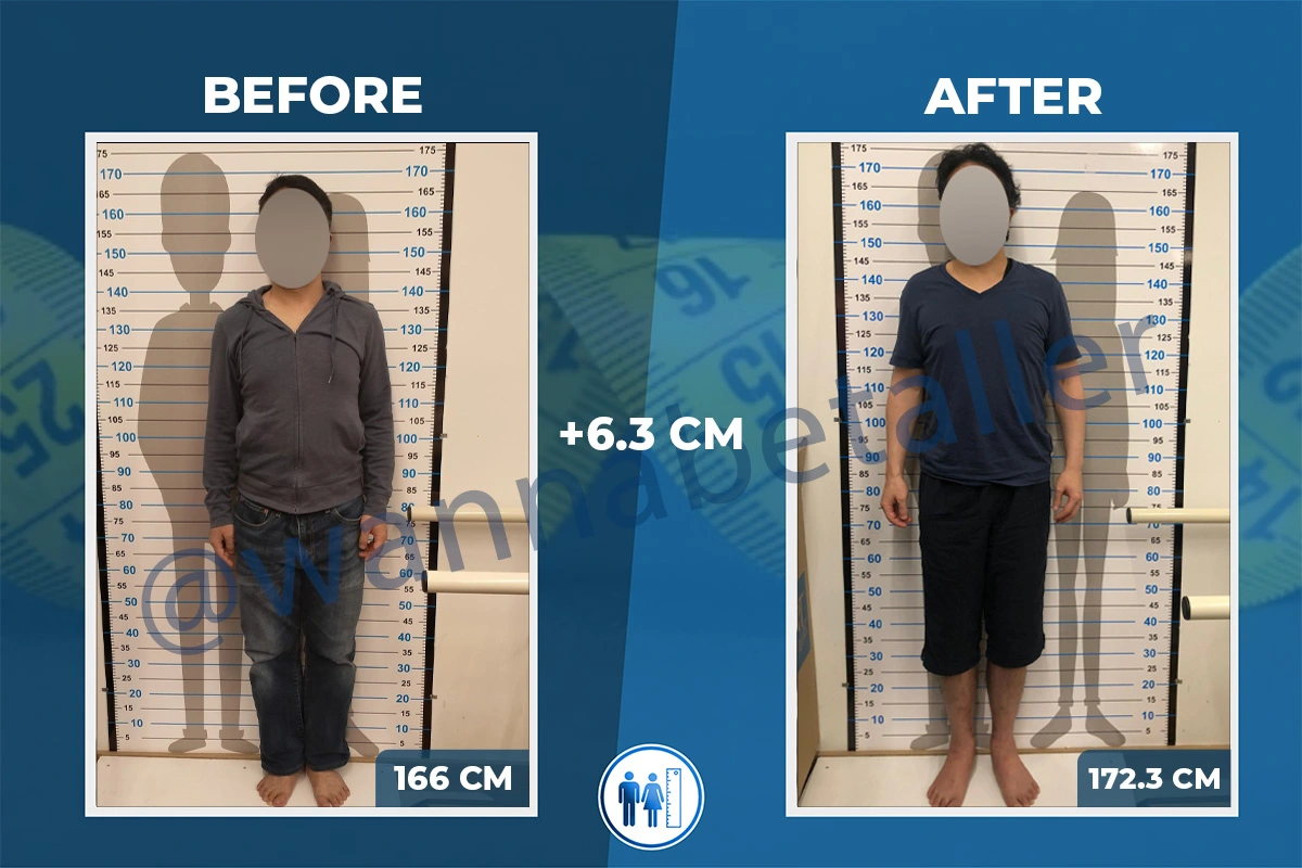 Limb Lengthening Surgery Before & After