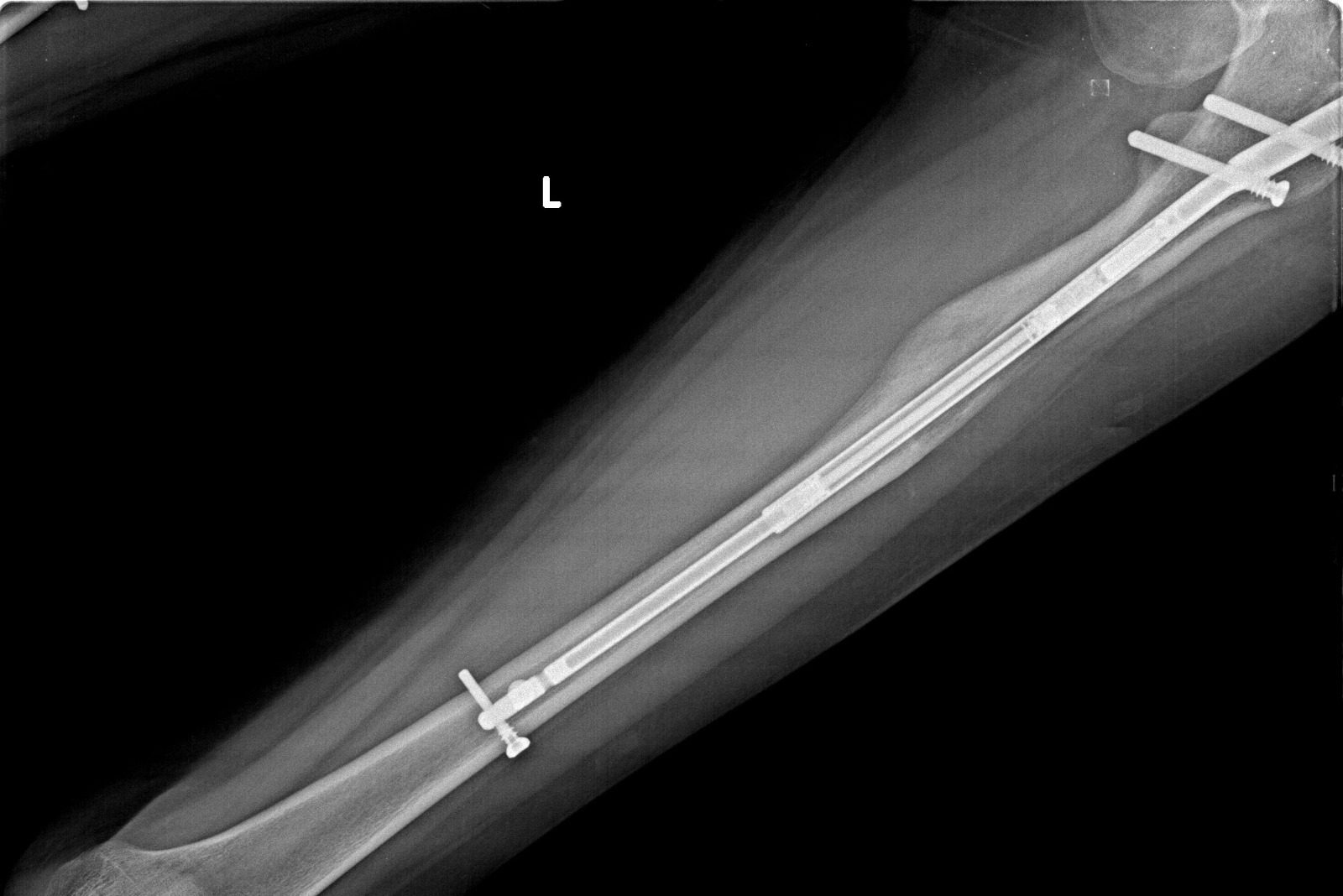 Limb Lengthening Surgery Precice 2.2 Method X-Ray