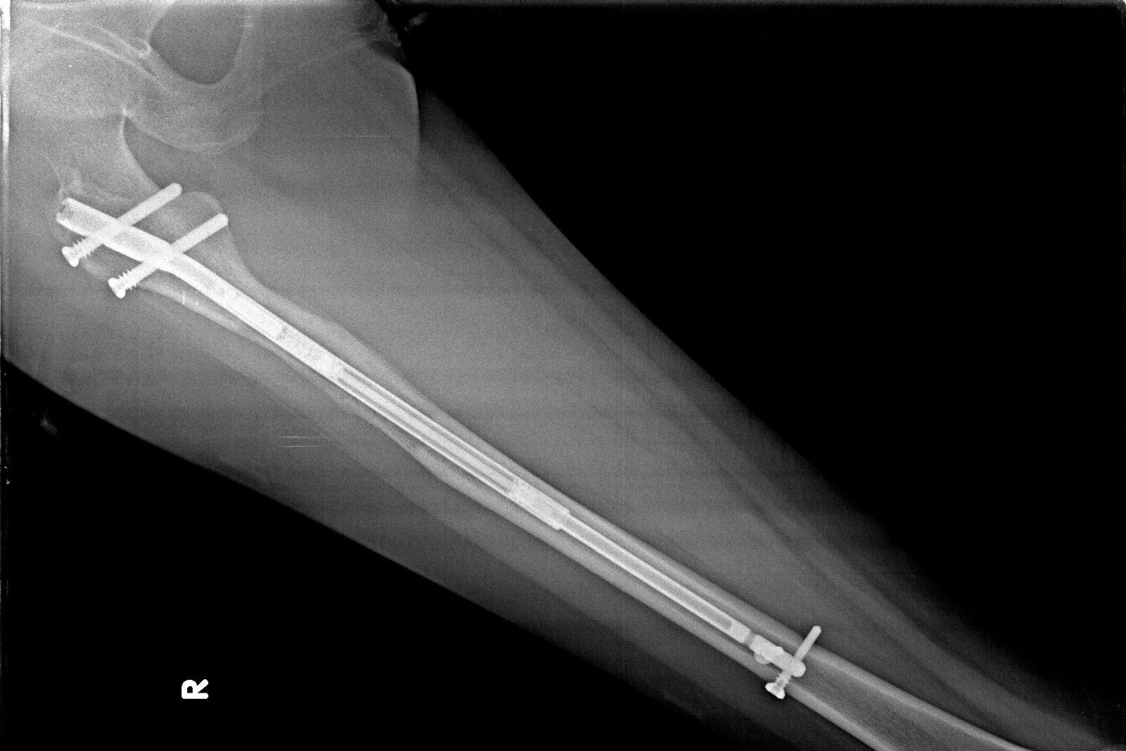 Limb Lengthening Surgery Stryde Method X-Ray