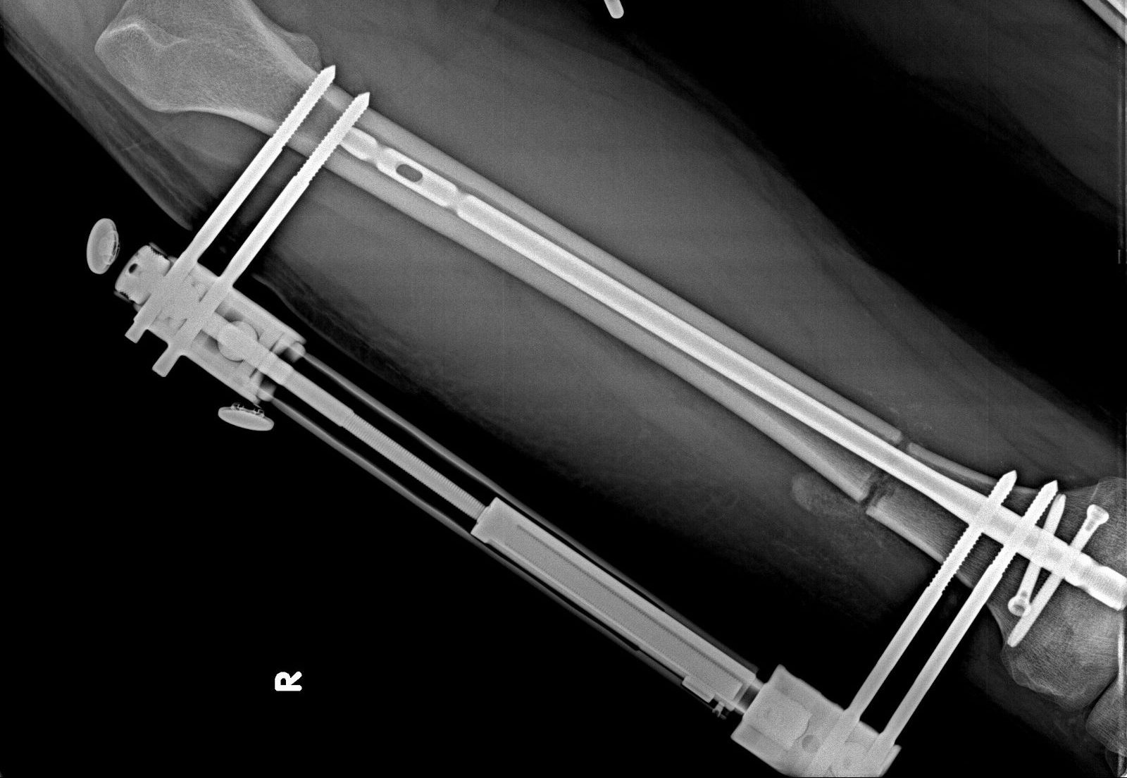 Limb Lengthening Surgery Lon Method X-Ray