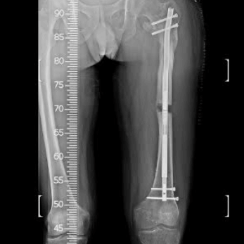 Wanna Be Taller x-ray