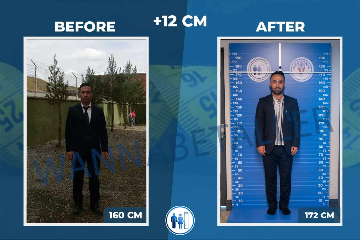 ibrahim-algan-before-after-limb-lengthening-surgery