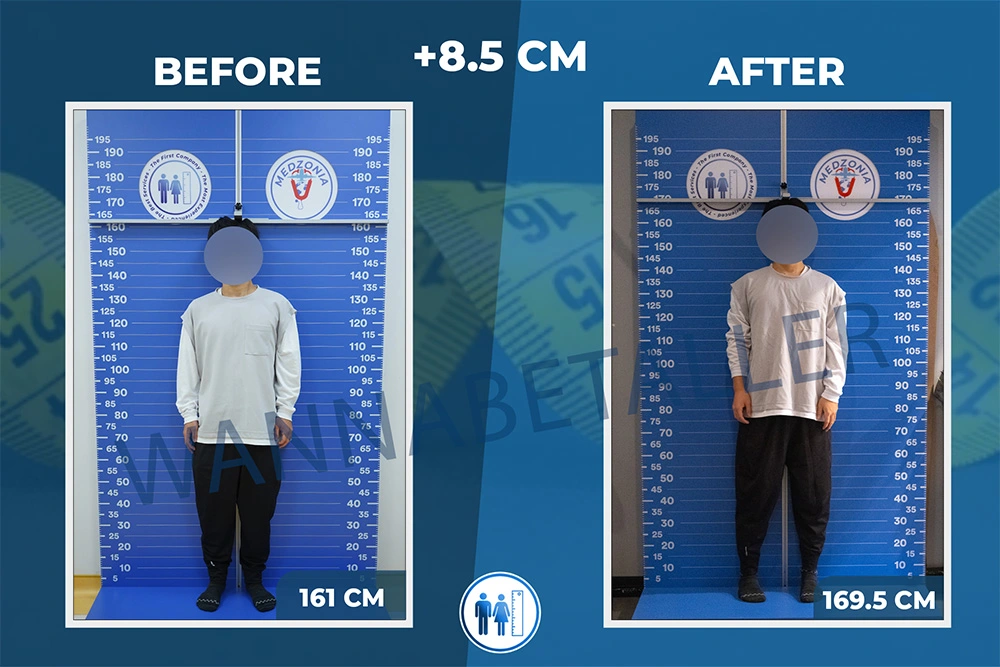 limb-lengthening-surgery-before-after-20