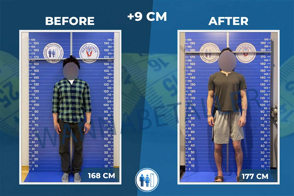 limb-lengthening-surgery-before-after-26