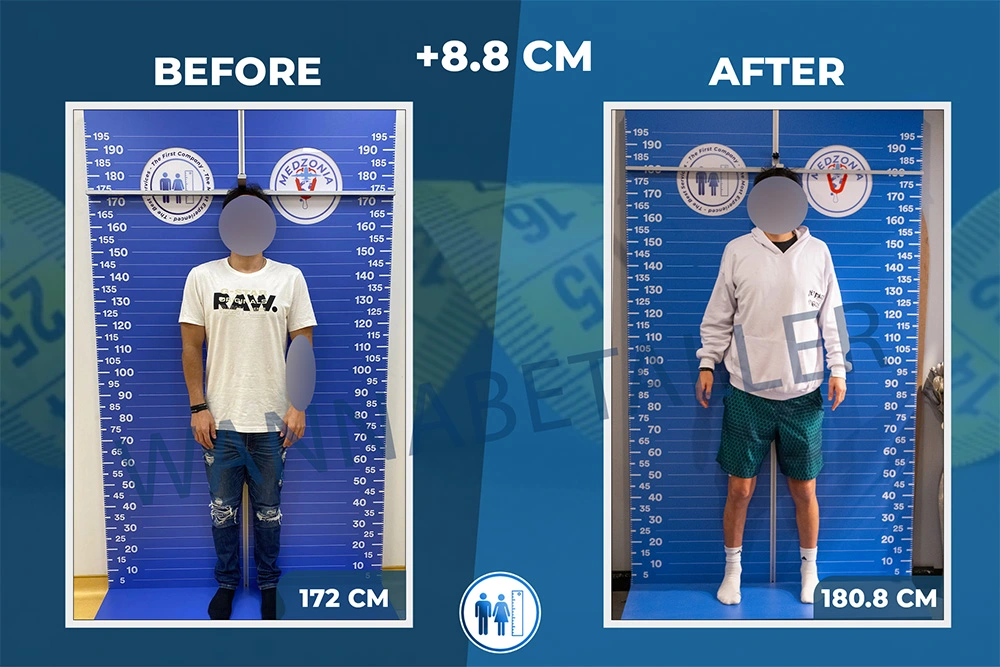 limb-lengthening-surgery-before-after-27