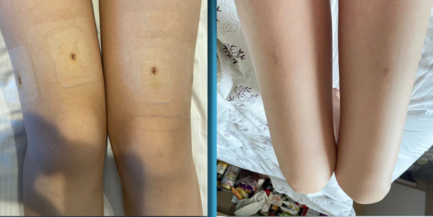 Precice 2 incisions