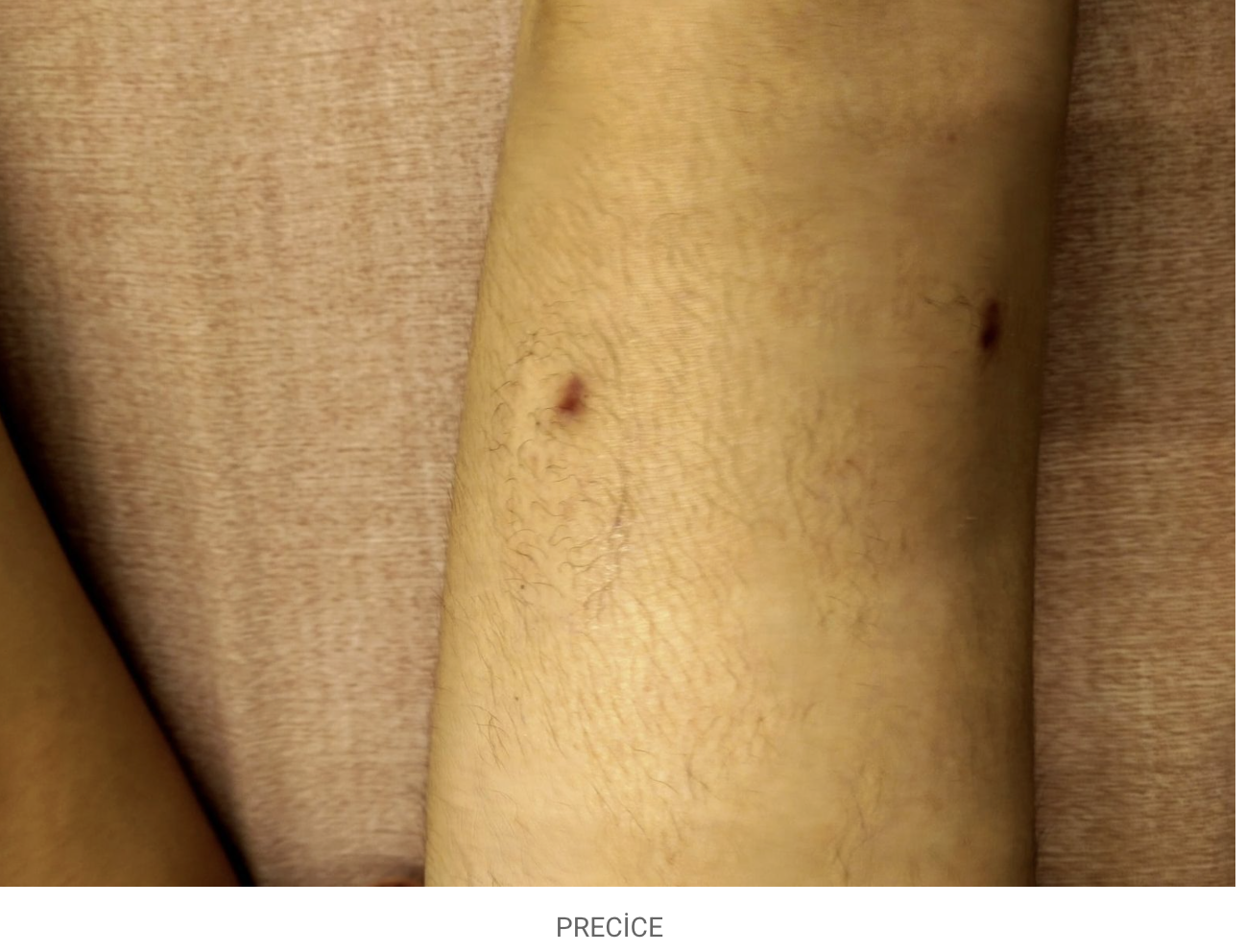 Precice 2 incisions