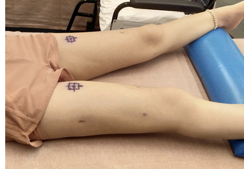 Precice 2 incisions