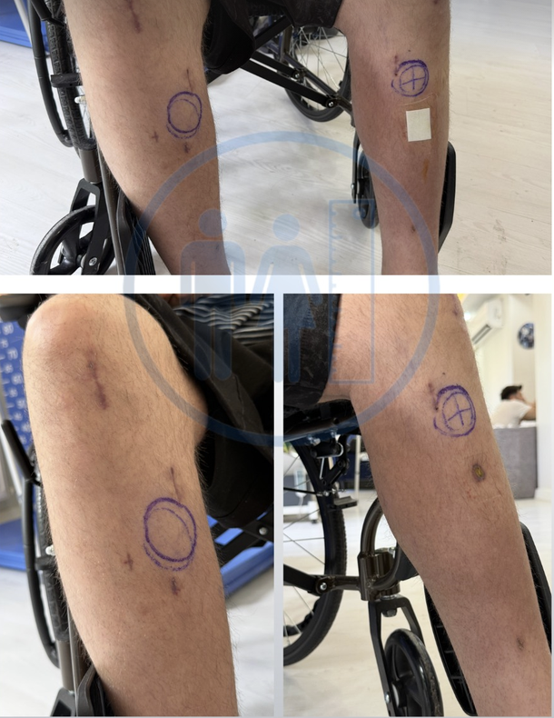 Fitbone incisions