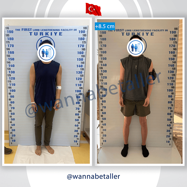 Mehmet before and after 8.5 cm limb lengthening