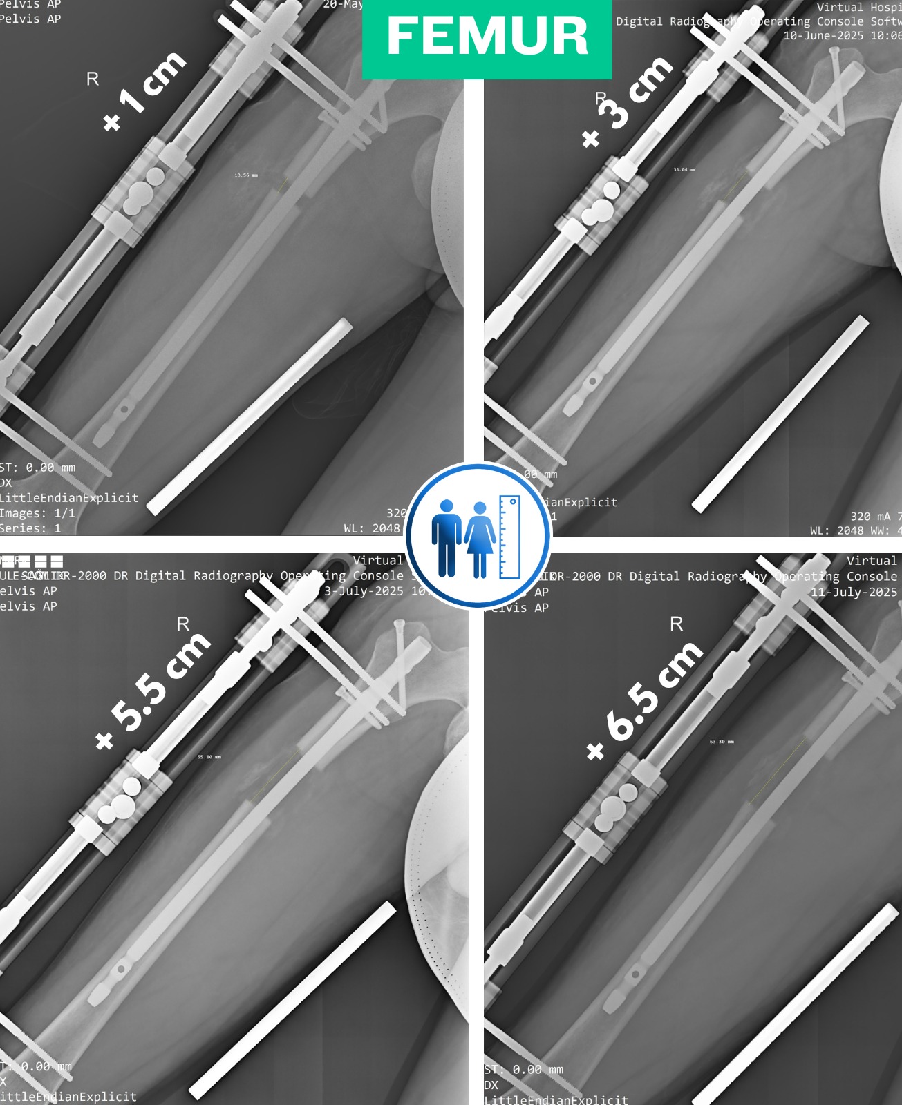 X-rays after the femur limb lengthening.