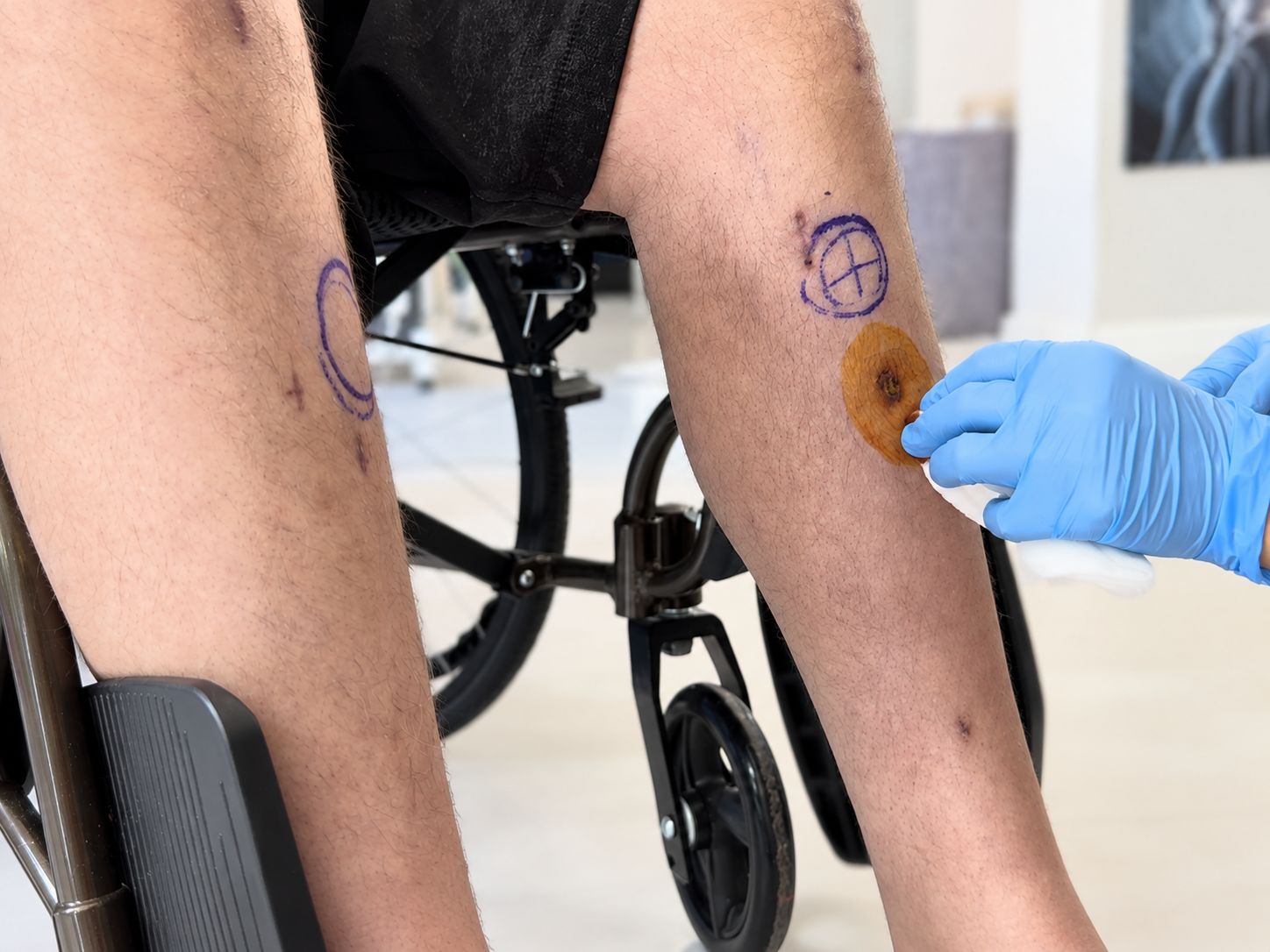 Fitbone incision dressing, second view
