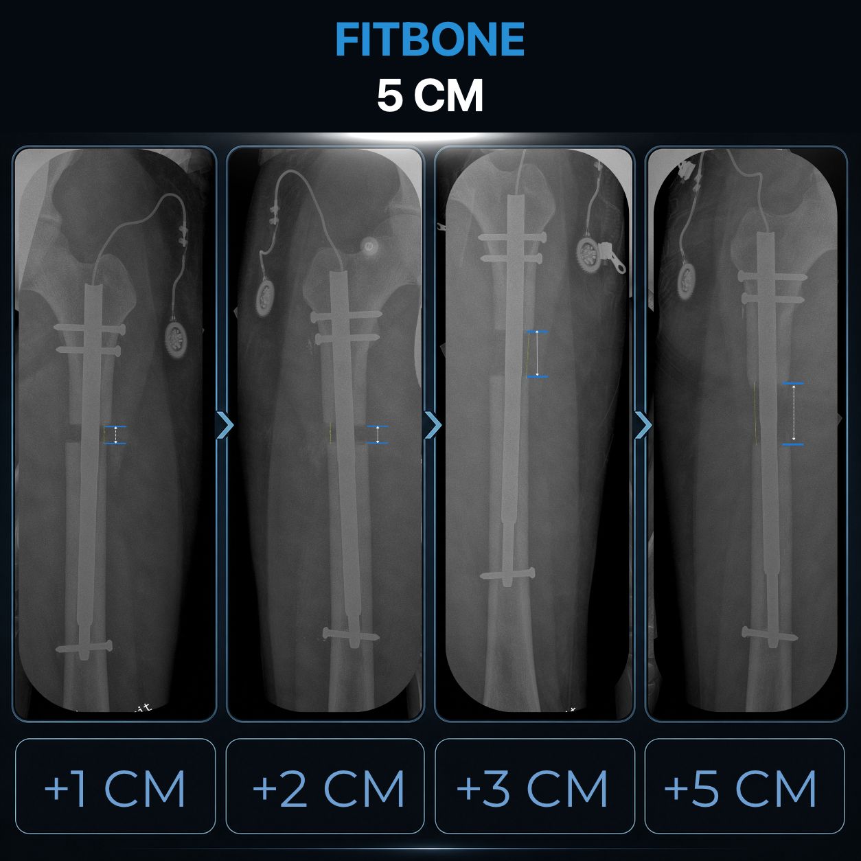 Fitbone follow-up X-ray during consolidation