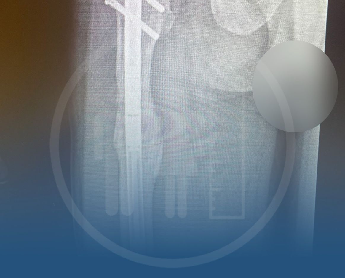 Precice 2 X-ray showing fully consolidated bone