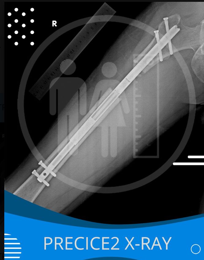 Annotated follow-up X-ray reviewed by the surgeon