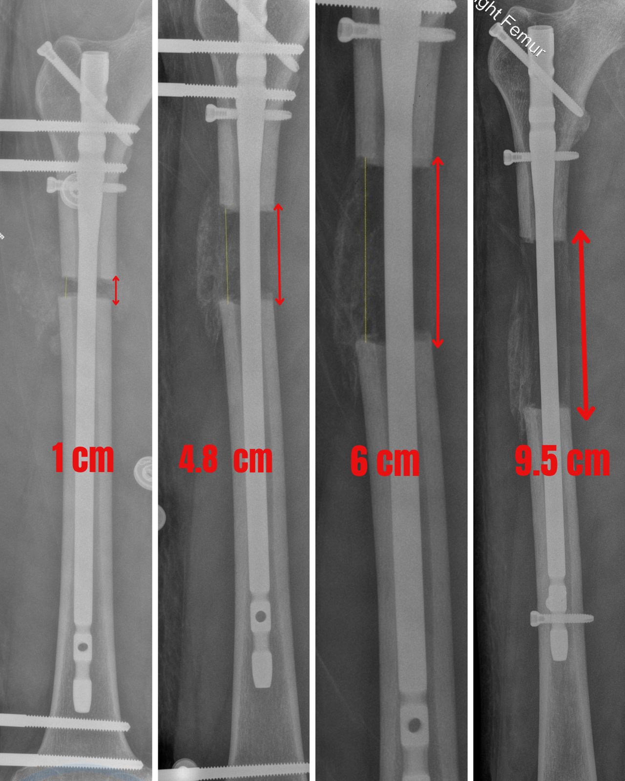 LON follow-up X-ray during lengthening