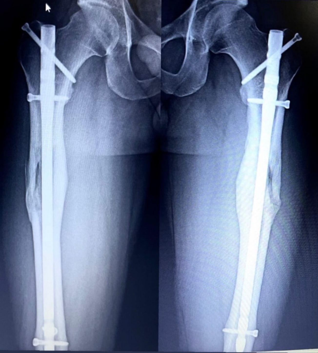 LON X-ray showing fully consolidated bone after fixator removal