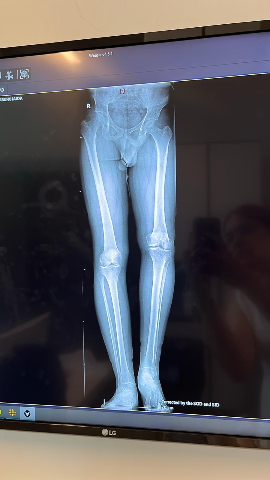 수술 계획에 사용하는 하지 전장 X선 영상