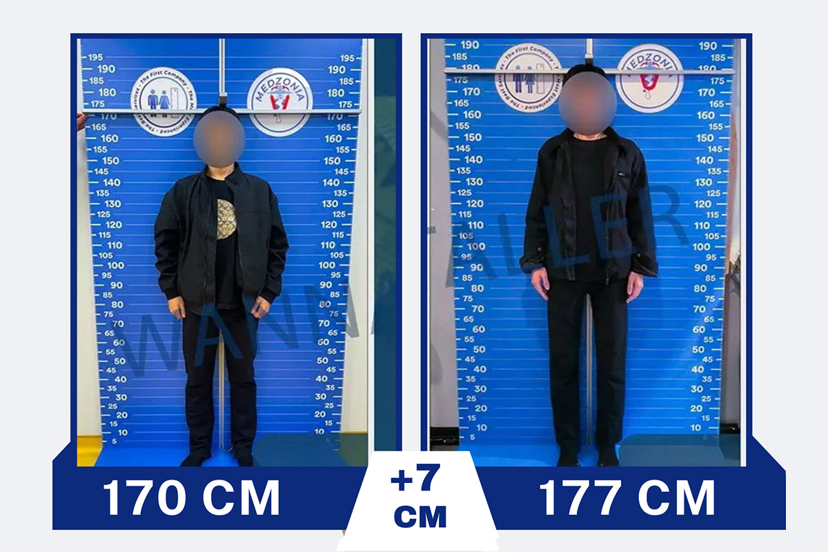 Before After 23