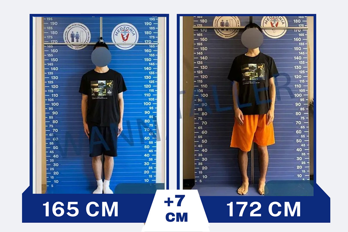 Before After 27