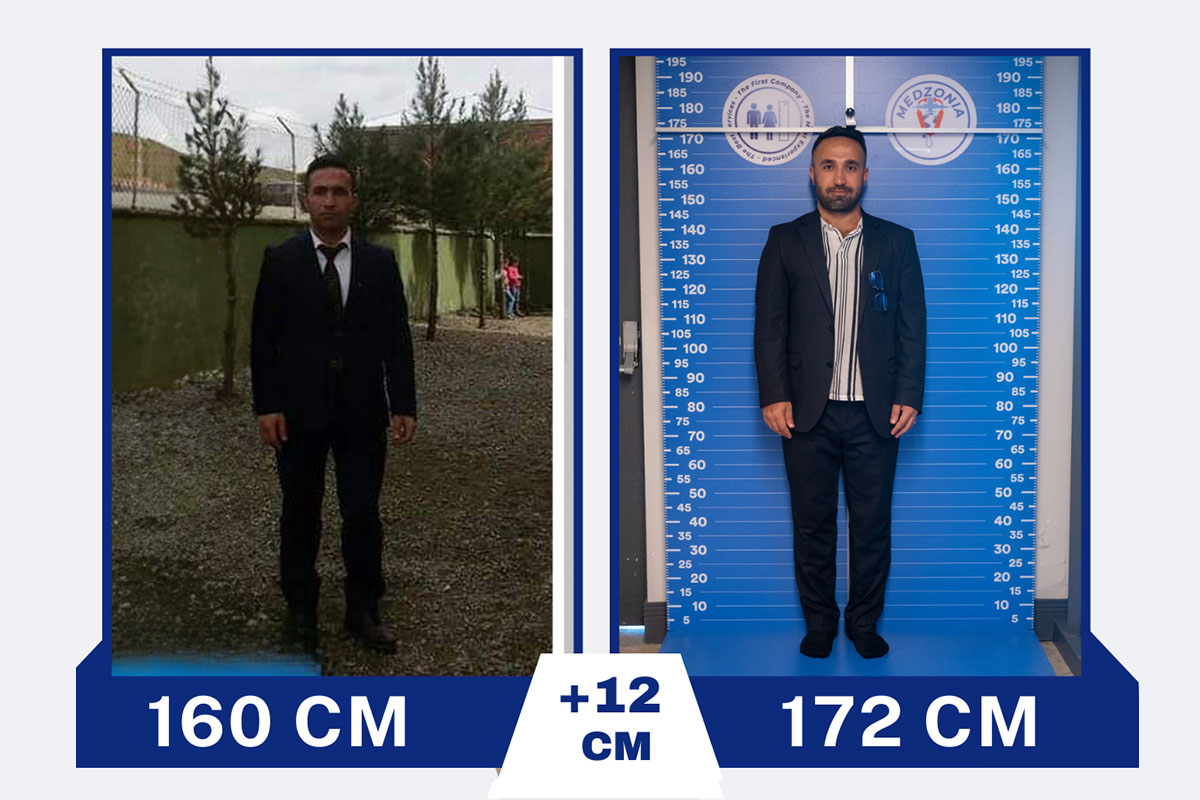 Before After 5