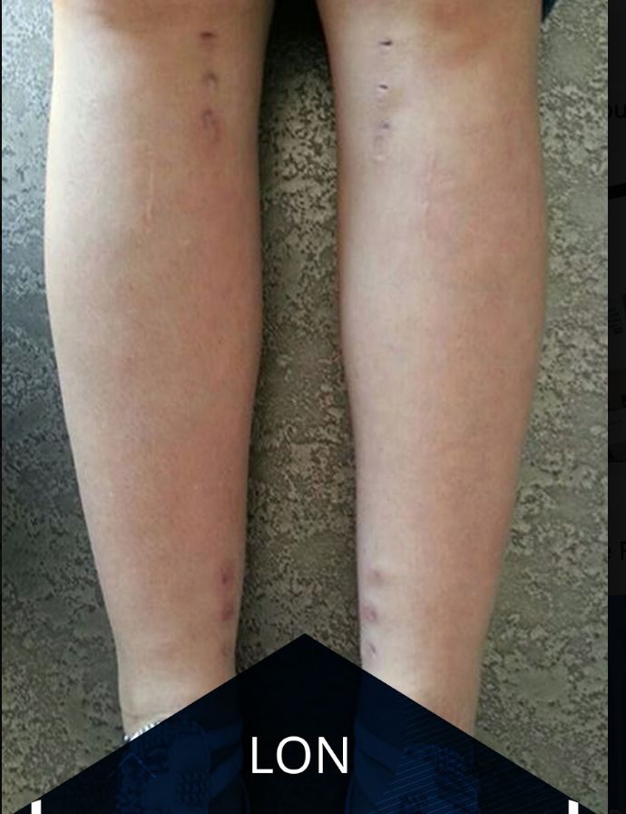 Internal nail incisions