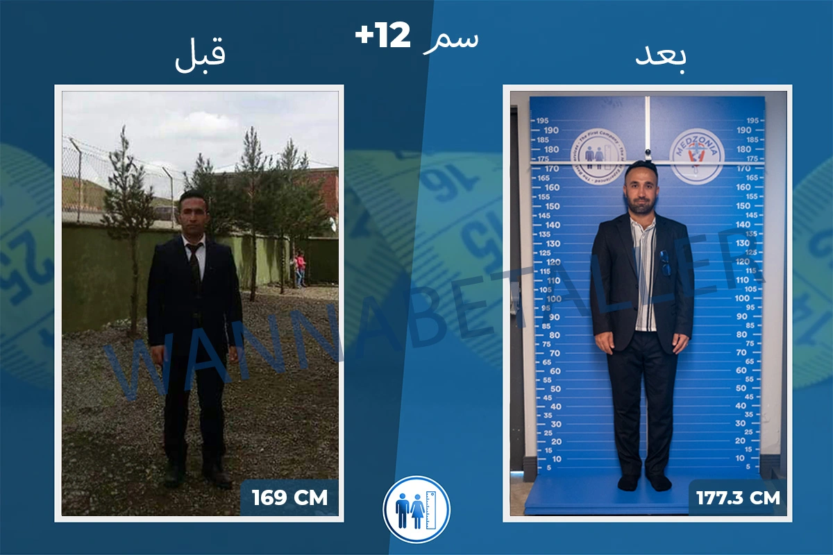 ibrahim-algan-before-after-limb-lengthening-surgery-ar