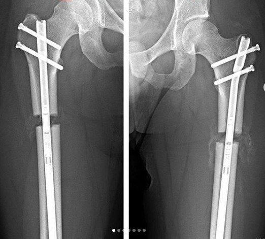 limb lengthening in turkey and rest of the world