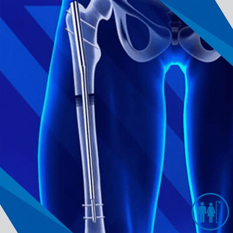 Intramedullary lengthening nails