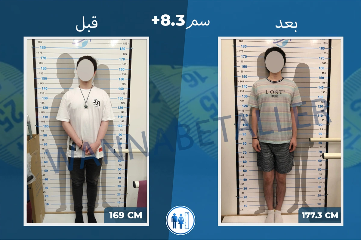 limb-lengthening-surgery-before-after-ar-10