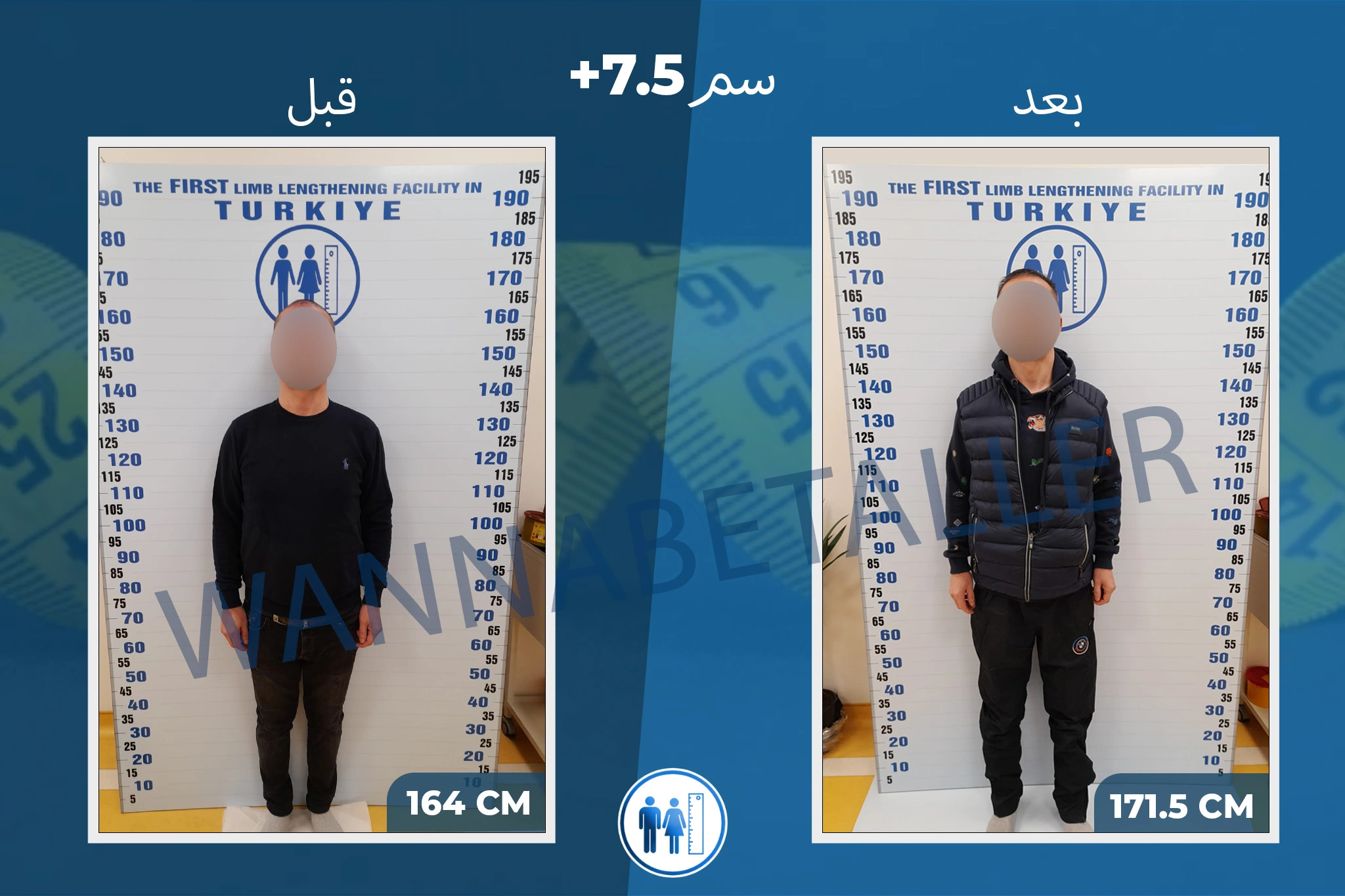 limb-lengthening-surgery-before-after-ar-11